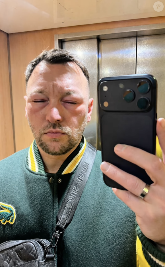 La réaction a été telle que son visage a gonflé et il ne parvenait plus à respirer : "Je suis dans un état... Elephant Man", a-t-il précisé.

Capture d'écran Instagram de Kevin Debonne.