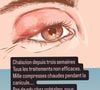 Elle a révélé souffrir d’un chalazion à l’œil droit depuis plusieurs semaines et les traitements ne fonctionnent pas

Faustine Bollaert sur Instagram