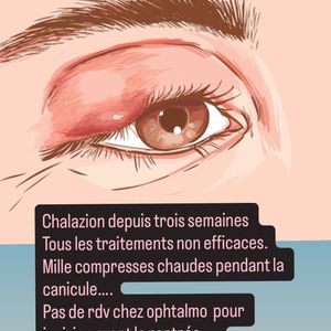 Elle a révélé souffrir d’un chalazion à l’œil droit depuis plusieurs semaines et les traitements ne fonctionnent pas

Faustine Bollaert sur Instagram