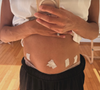 "Mise à jour 10 jours après la chirurgie : encore gonflée, douleur à 4/10 si je ne loupe pas mes heures de prise de médicaments."
