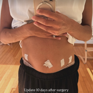 "Mise à jour 10 jours après la chirurgie : encore gonflée, douleur à 4/10 si je ne loupe pas mes heures de prise de médicaments."