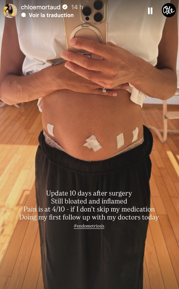 "Mise à jour 10 jours après la chirurgie : encore gonflée, douleur à 4/10 si je ne loupe pas mes heures de prise de médicaments."