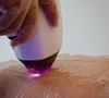 Le traitement au laser, lui, balaye plus rapidement les grandes zones grâce au ciblage de la mélanine.
