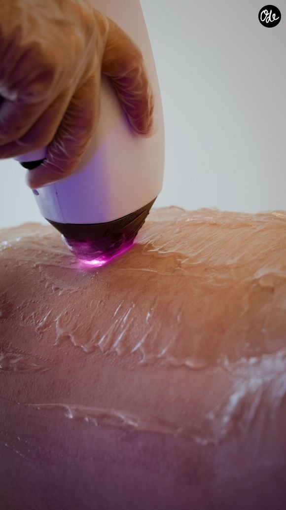 Le traitement au laser, lui, balaye plus rapidement les grandes zones grâce au ciblage de la mélanine.