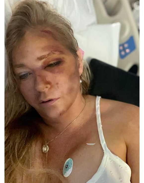 Son véhicule a été percuté par un bus roulant à 110km/h. Hospitalisée, elle a le visage tuméfié et des bleus importants comme elle l'a dévoilé sur Instagram
Virginia Giuffre victime d'un accident de la route